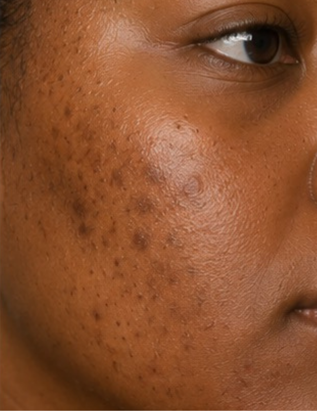 Close-up of a person's face showing skin texture and blemishes on the cheek.